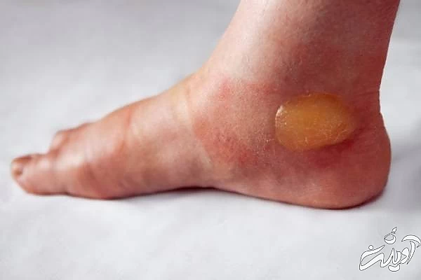 تاول دیابتی 